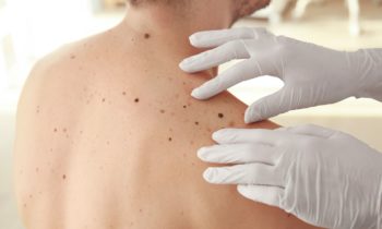 What to Expect During a Skin Check