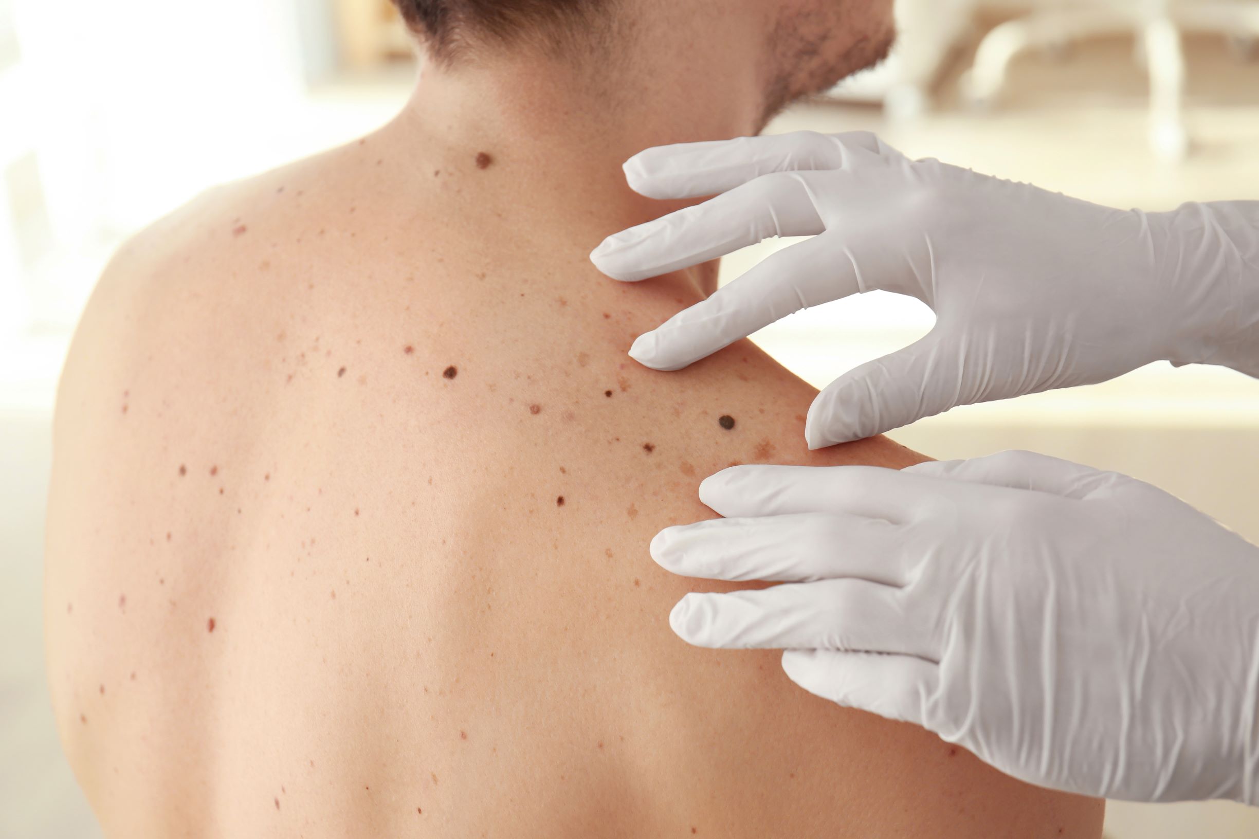 Dermatologist performing skin check on male patient Dermatologist performing skin check on male patient