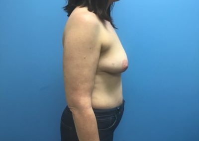 After breast reconstruction side view of patient's chest.