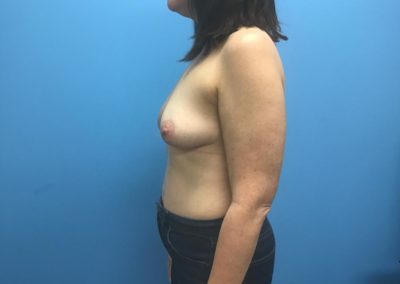 After breast reconstruction side view of patient's chest.