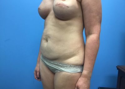 Bilateral breast reconstruction after filler injection side view of patient's chest and abdomen.