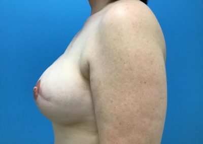 Breast and nipple reconstruction after procedure side view of patient's chest.