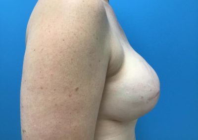 Breast and nipple reconstruction before procedure side view of patient's chest.