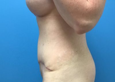 Tummy tuck abdominoplasty patient after side view picture.