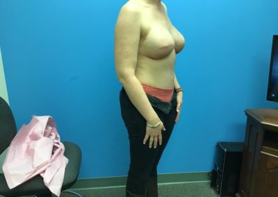 Tummy tuck and nipple reconstruction before procedure side view of patient's chest and abdomen.