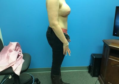 Tummy tuck and nipple reconstruction before procedure front view of patient's chest and abdomen.